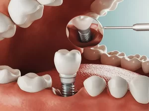 قیمت ایمپلنت دندان