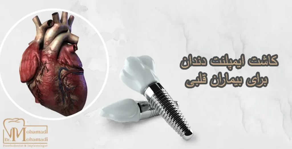 کاشت ایمپلنت دندان برای بیماران قلبی